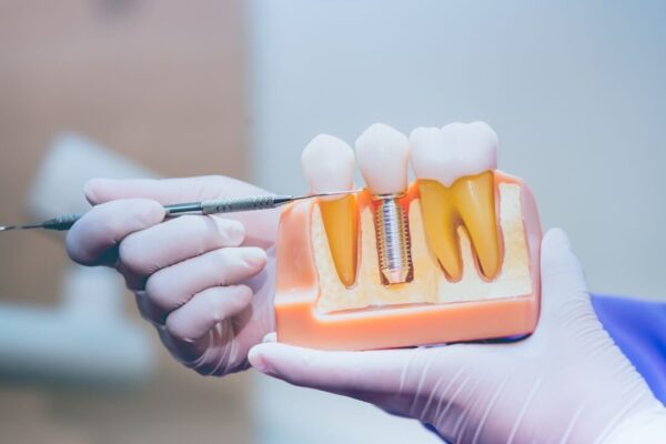 Les étapes clés pour fixer une couronne dentaire